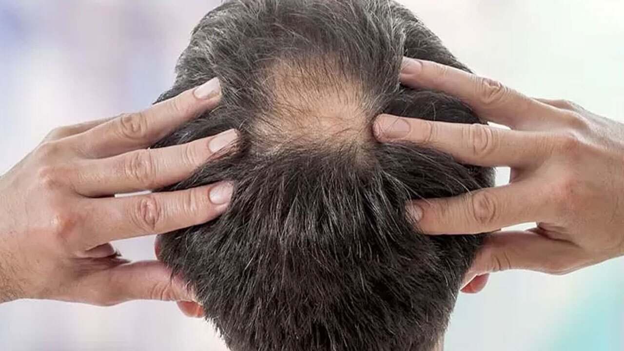 علل و راه های درمان ریزش مو + فیلم