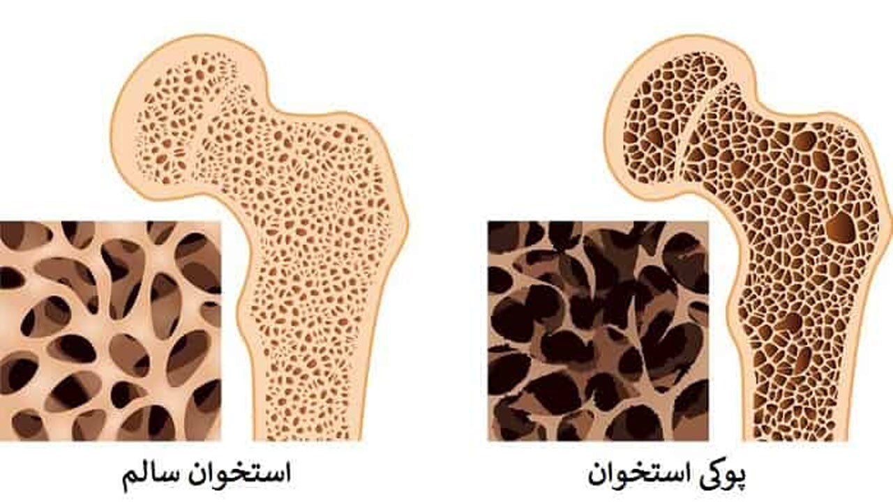 راه های پیشگیری و درمان بیماری پوکی استخوان + فیلم