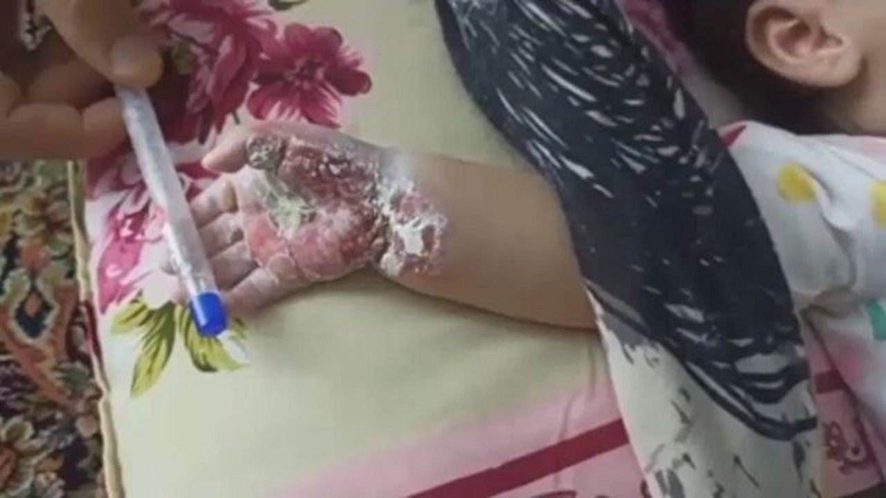 پاسخ بیمارستان رازی به ماجرای سوختگی دست نوزاد + فیلم