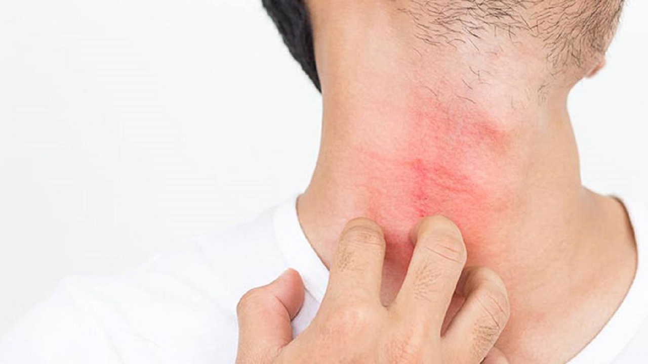 درمان کهیر به کمک طب سنتی + فیلم