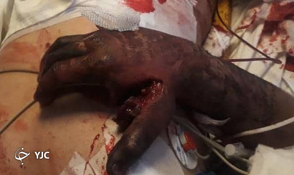 جوان ۲۳ ساله جهرمی بر اثر انفجار ترقه مصدوم شد