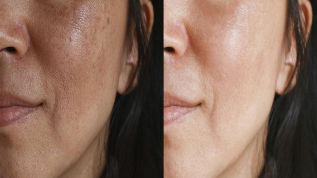 با ۶ راهکار از شر لکه‌های پوستی خلاص شوید!