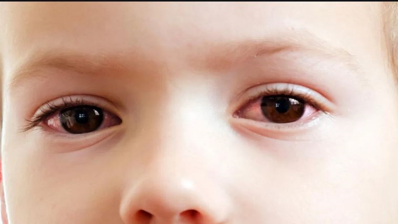 چه زمانی قرمزی چشم‌ها خطرناک است؟