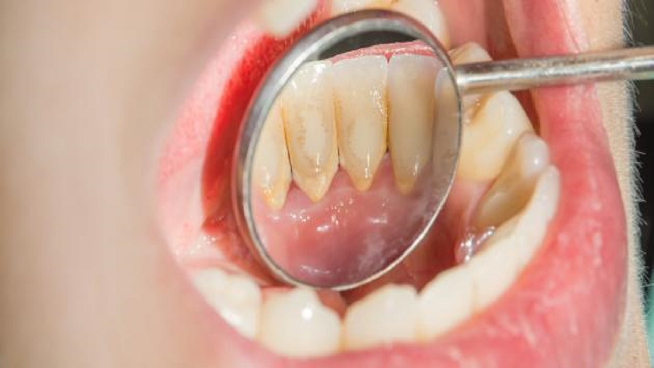آنچه باید درباره کلسیفیکاسیون دندان بدانیم