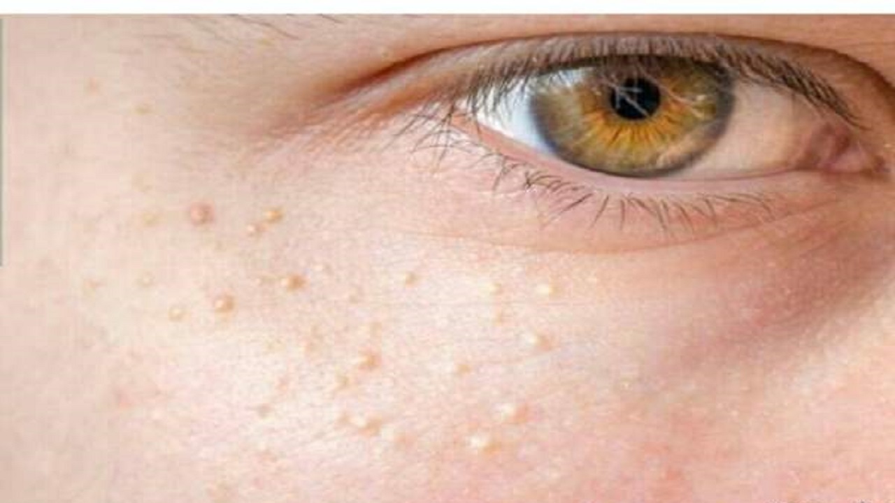 برآمدگی‌های سفید اطراف چشم خطرناک هستند؟/ همه‌چیز درباره میلیا