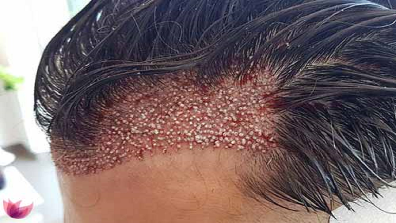 جراحی کاشت مو، کار دست این مرد کچل داد + عکس