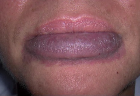 کبودی لب