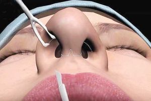 افتادگی دریچه بینی افتادگی دریچه بینی