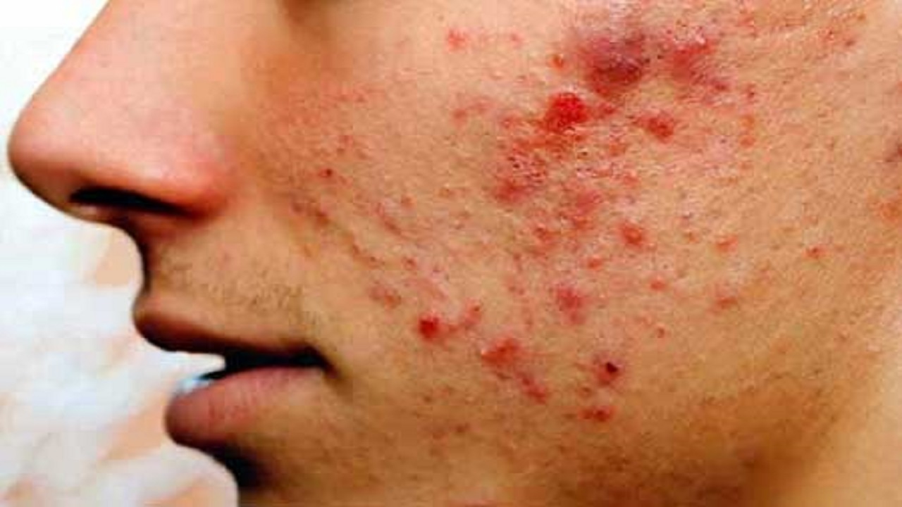 چه غذاهایی باعث بروز آکنه می شوند؟