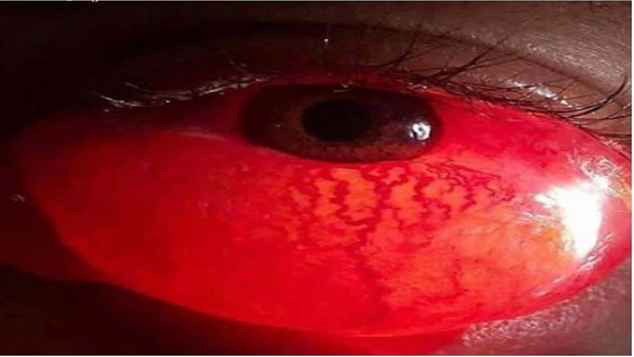 علل بیماری کموسیس چشمی از کجا نشات می گیرد؟