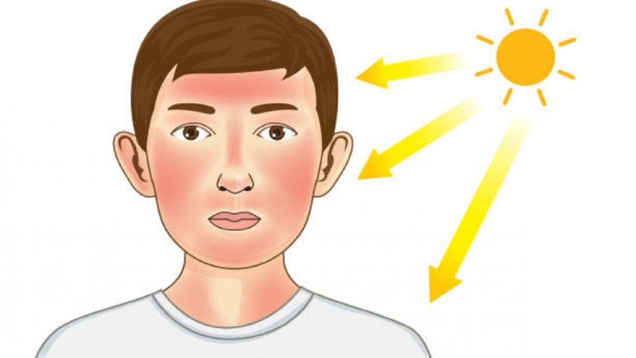 کار‌هایی که پس از ابتلا به آفتاب سوختگی نباید انجام داد