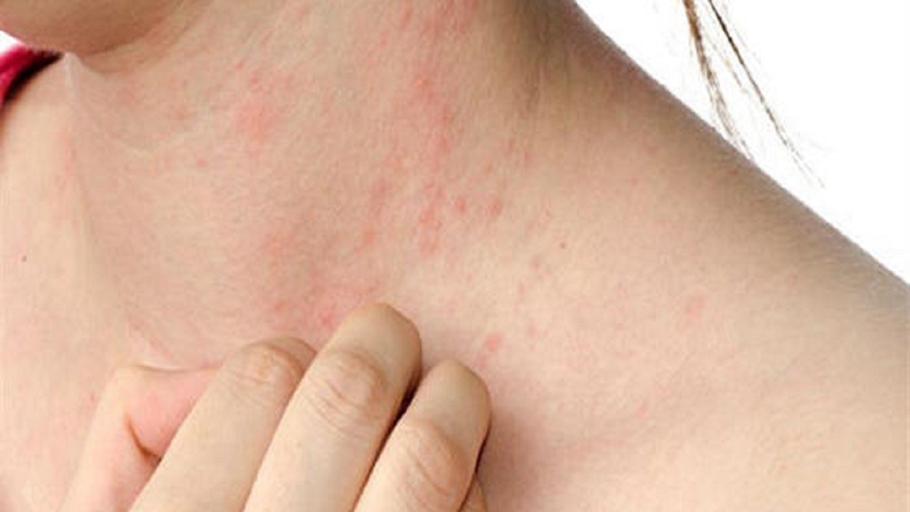 مشکلات پوستی مشکلات پوستی