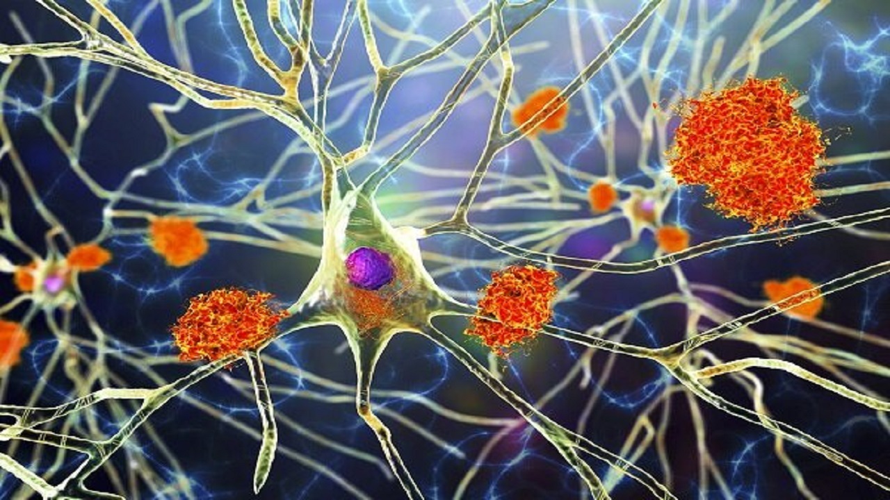 تاثیر برخی دارو‌های دیابت در پیشگیری از پیشرفت آلزایمر