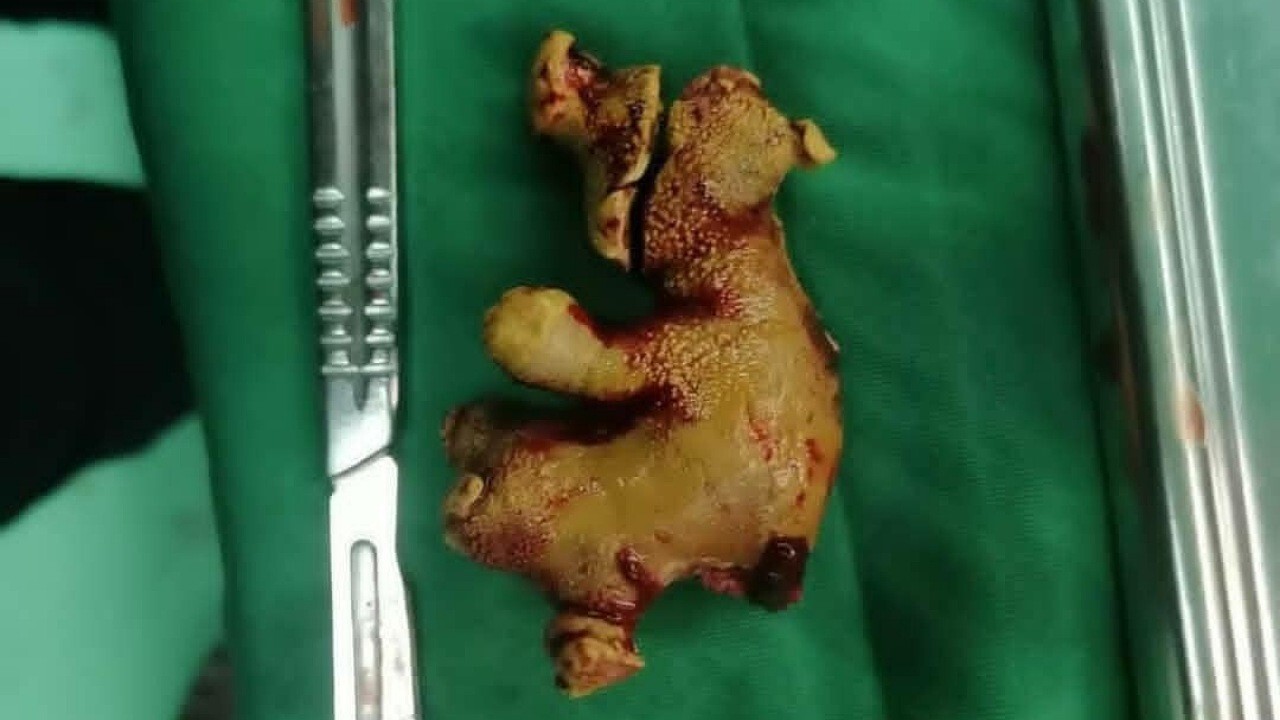 خارج کردن سنگ شاخ گوزنی از کلیه یک خانم کهنوجی