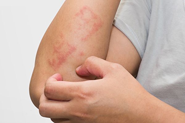 تحریکات پوستی تحریکات پوستی