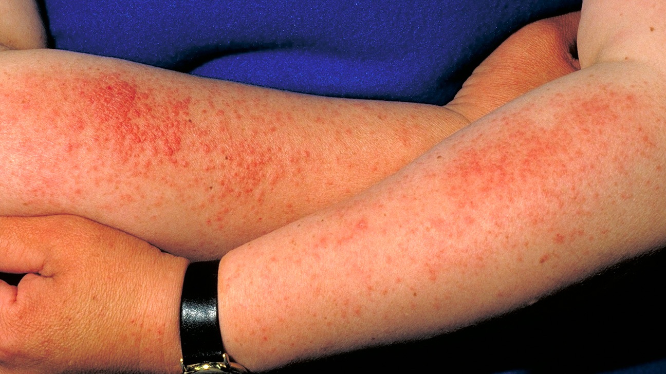 حساسیت پوستی به آب
