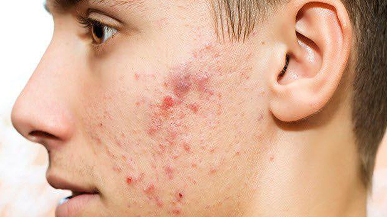 محل ایجاد جوش نشانه چیست؟