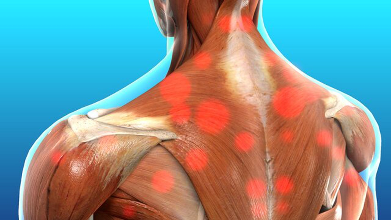 سندروم درد میوفاسیال گردن چیست؟