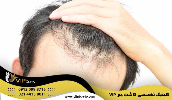 بررسی روش های کاشت مو/ مراقبت های قبل و بعد و هزینه عمل کاشت مو