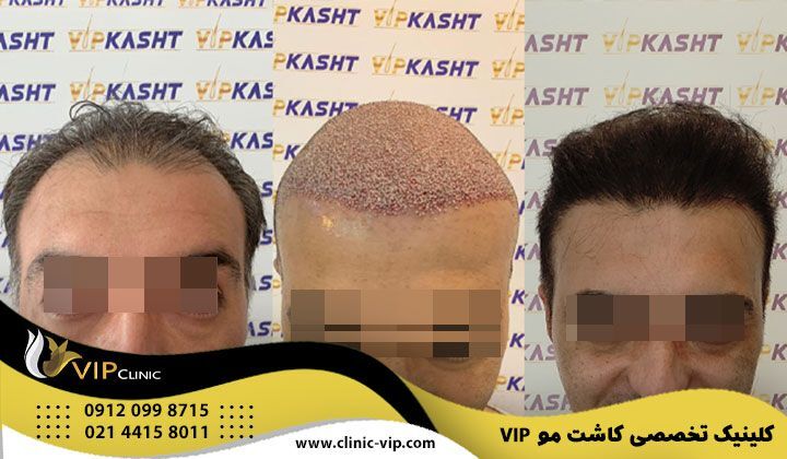 بررسی روش های کاشت مو/ مراقبت های قبل و بعد و هزینه عمل کاشت مو