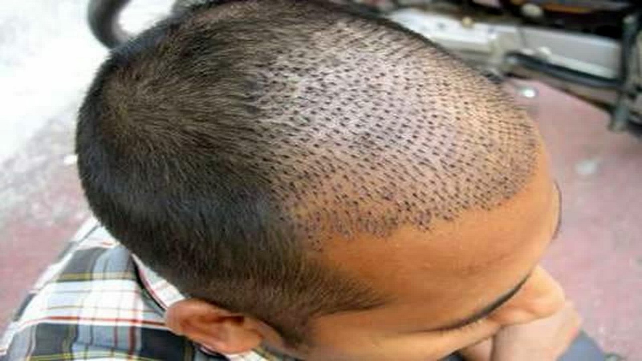 کاشت مو با قیمت پایین/ فریب وعده‌های دروغ را نخورید