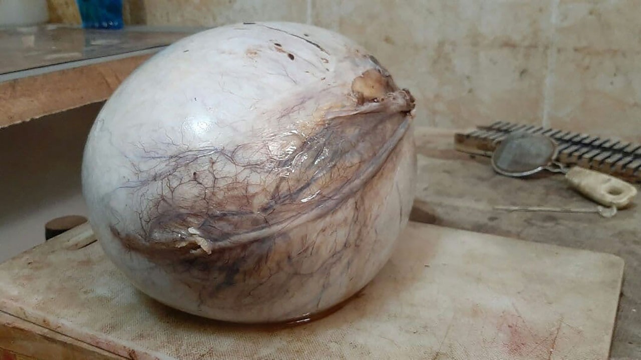خارج کردن یک توده چهار کیلویی از شکم یک زن مینابی