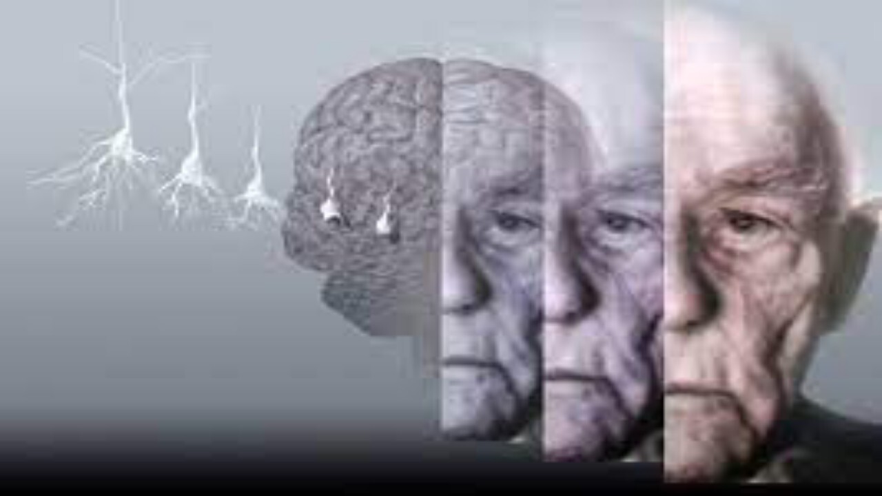 به صدا درآمدن زنگ خطر افزایش بیماری آلزایمر در قزوین