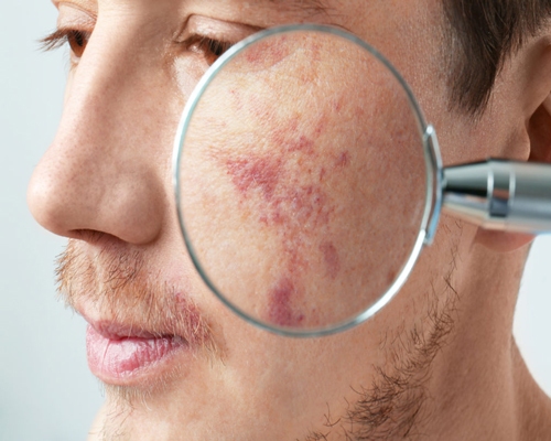 لکه&zwnj;های قرمز روی پوست
