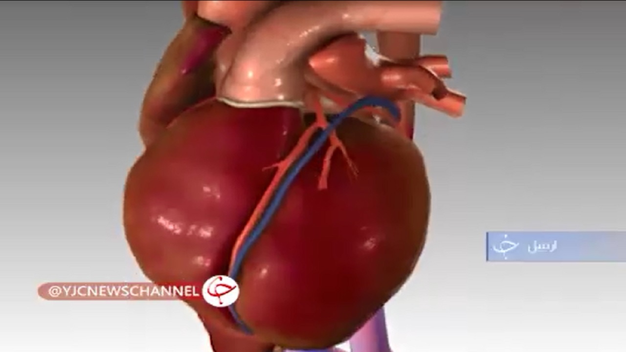 سندروم قلب شکسته چیست؟+فیلم