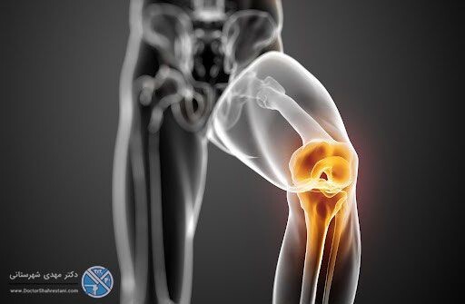 چگونه تشخیص بدهیم مینیسک زانویمان پاره شده است؟ چگونه تشخیص بدهیم مینیسک زانویمان پاره شده است؟