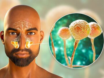 چه کسانی قارچ سیاه می&zwnj;گیرند؟