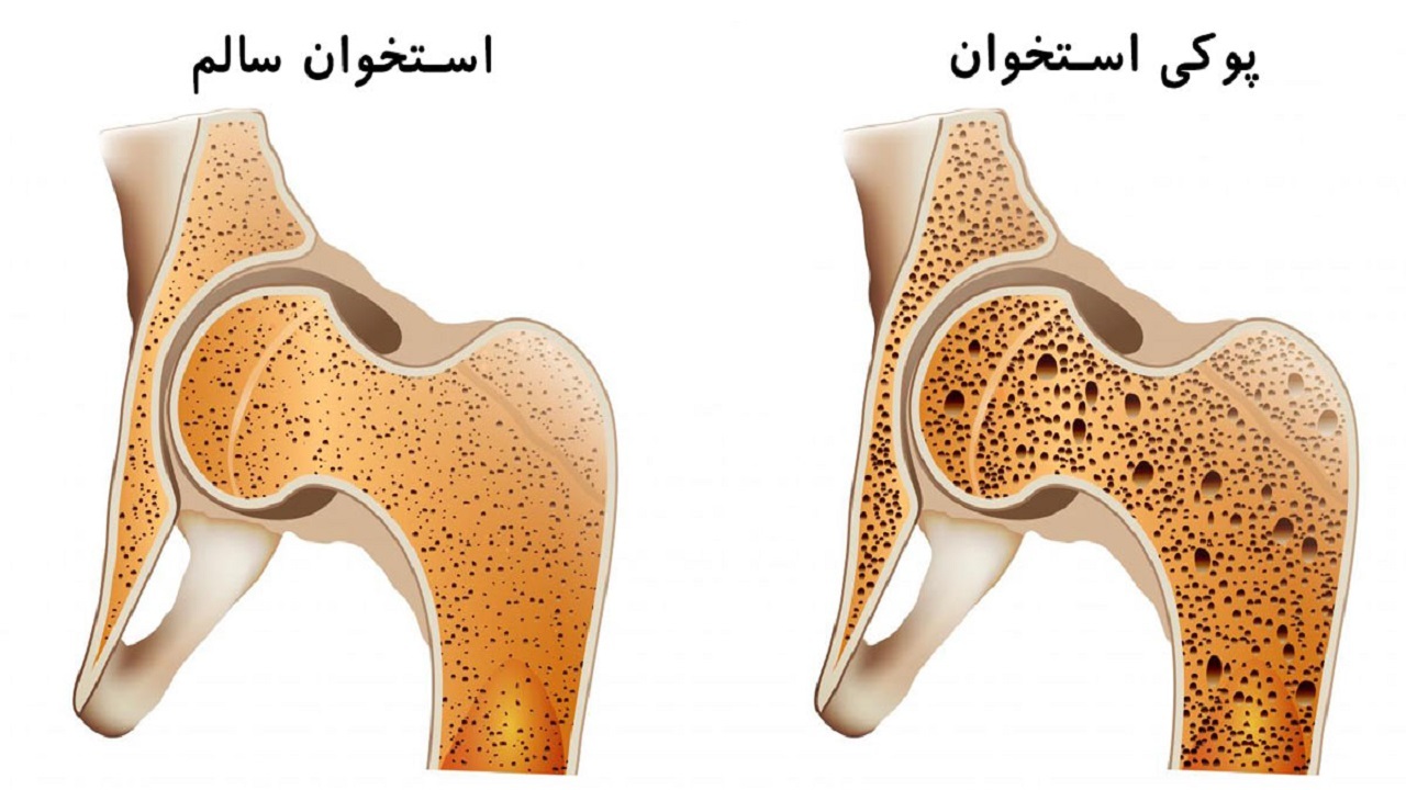 سن که رسید به ۵۰ باید مواظب این بیماری باشید/ مصرف لبنیات حافظ سلامت استخوان