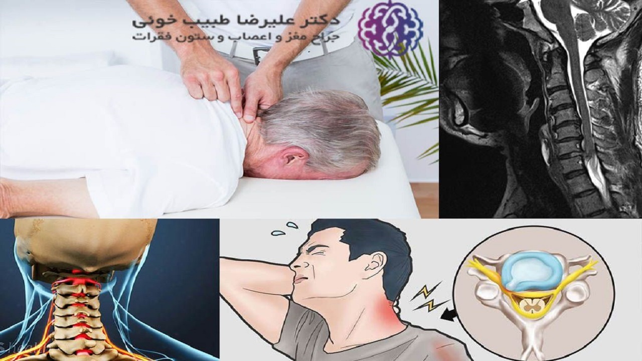 علائم و درمان دیسک گردن