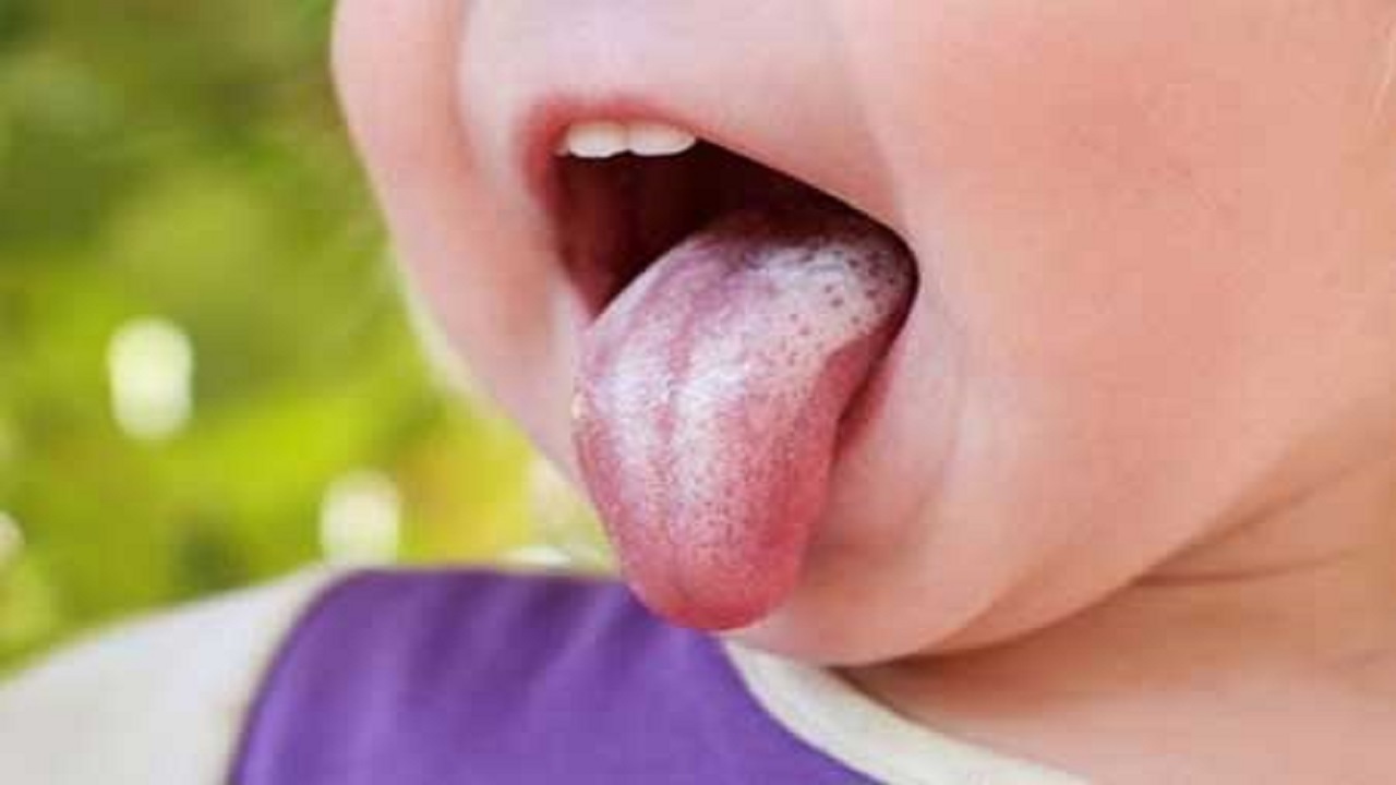 دهانشویه طبیعی برای درمان برفک دهان