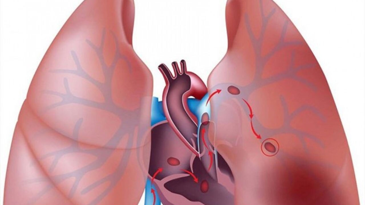 همه چیز در خصوص بیماری ریوی سی اف + فیلم
