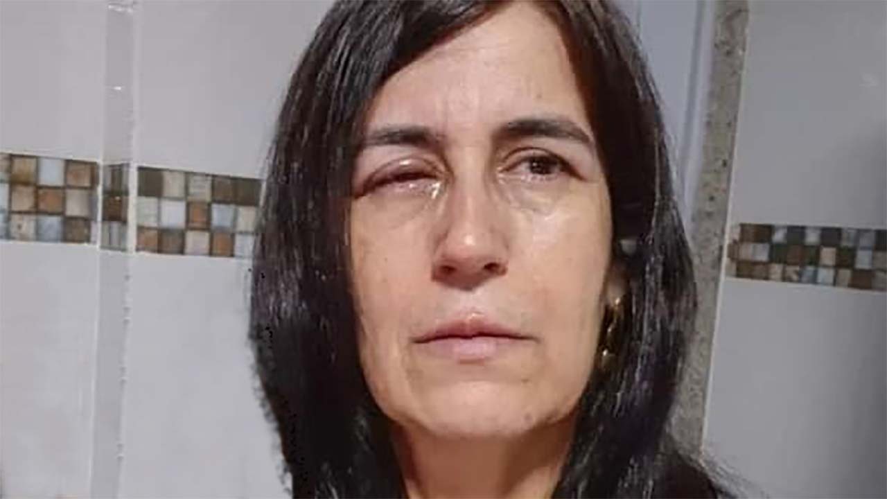 نابینا شدن موقتی یک زن در اثر استفاده از چسب قطره ای