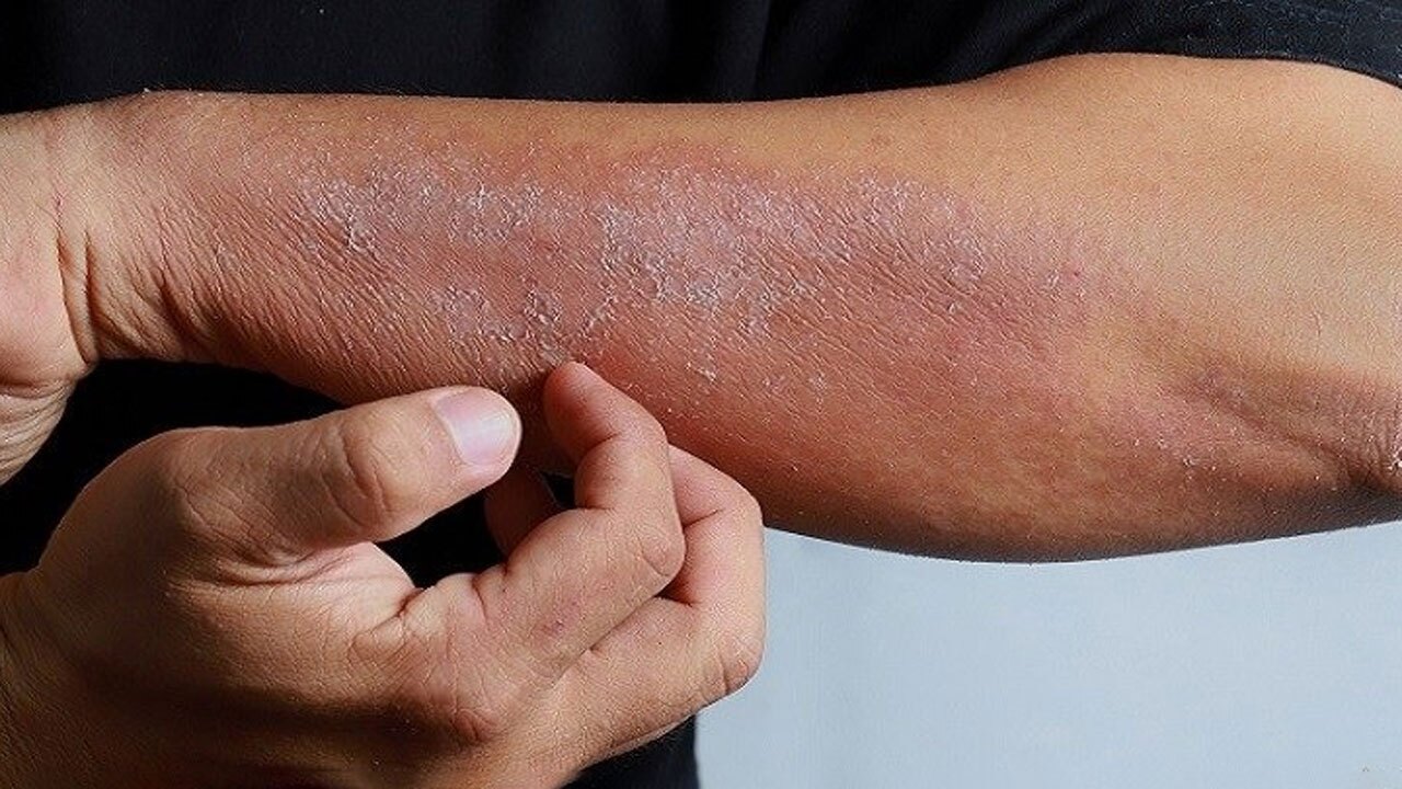 علل ابتلا و راه‌های درمان اگزمای پوستی + فیلم