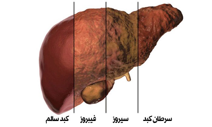اصلی&zwnj;ترین دلایل بروز کبد چرب غیرالکلی/////