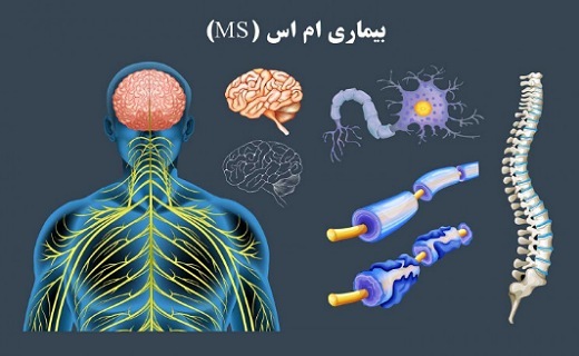 بیماری ام اس