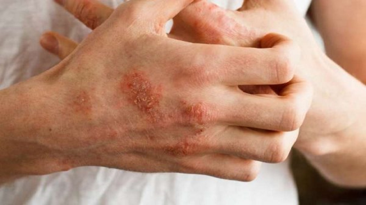 از راه&zwnj;های تشخیص آمبولی ریه تا ۱۰ دمنوش و چای موثر برای مقابله با سرماخوردگی