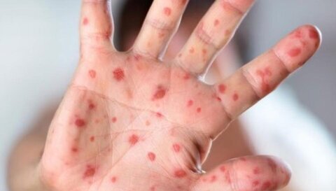 واکسیناسیون علیه سرخک تا کی وقت است؟