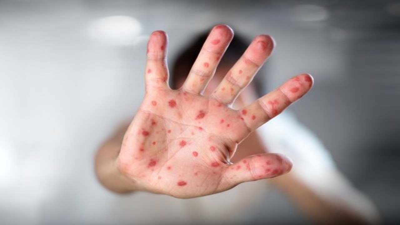 نگرانی‌ها از شیوع سرخک در افغانستان