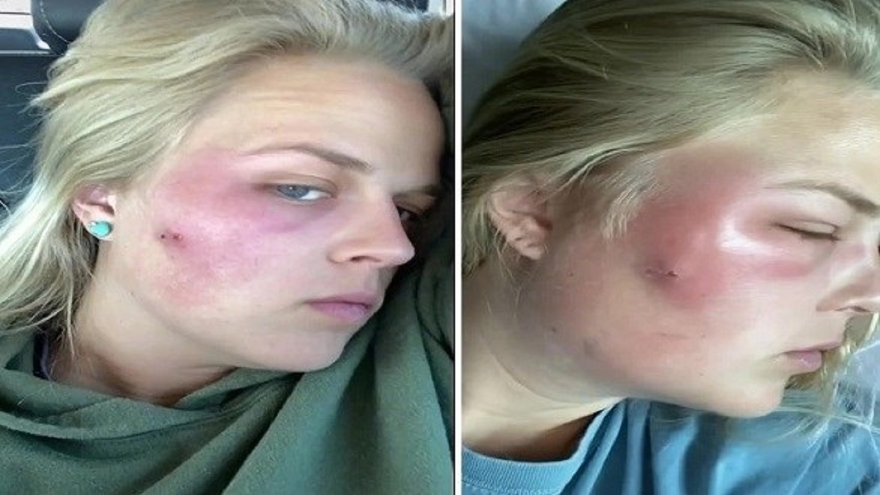 یک هفته بستری در بیمارستان عاقبت دستکاری جوش صورت!