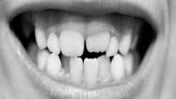 باشگاه خبرنگاران -چرا لثه‌ها عقب‌نشینی می‌کنند؟