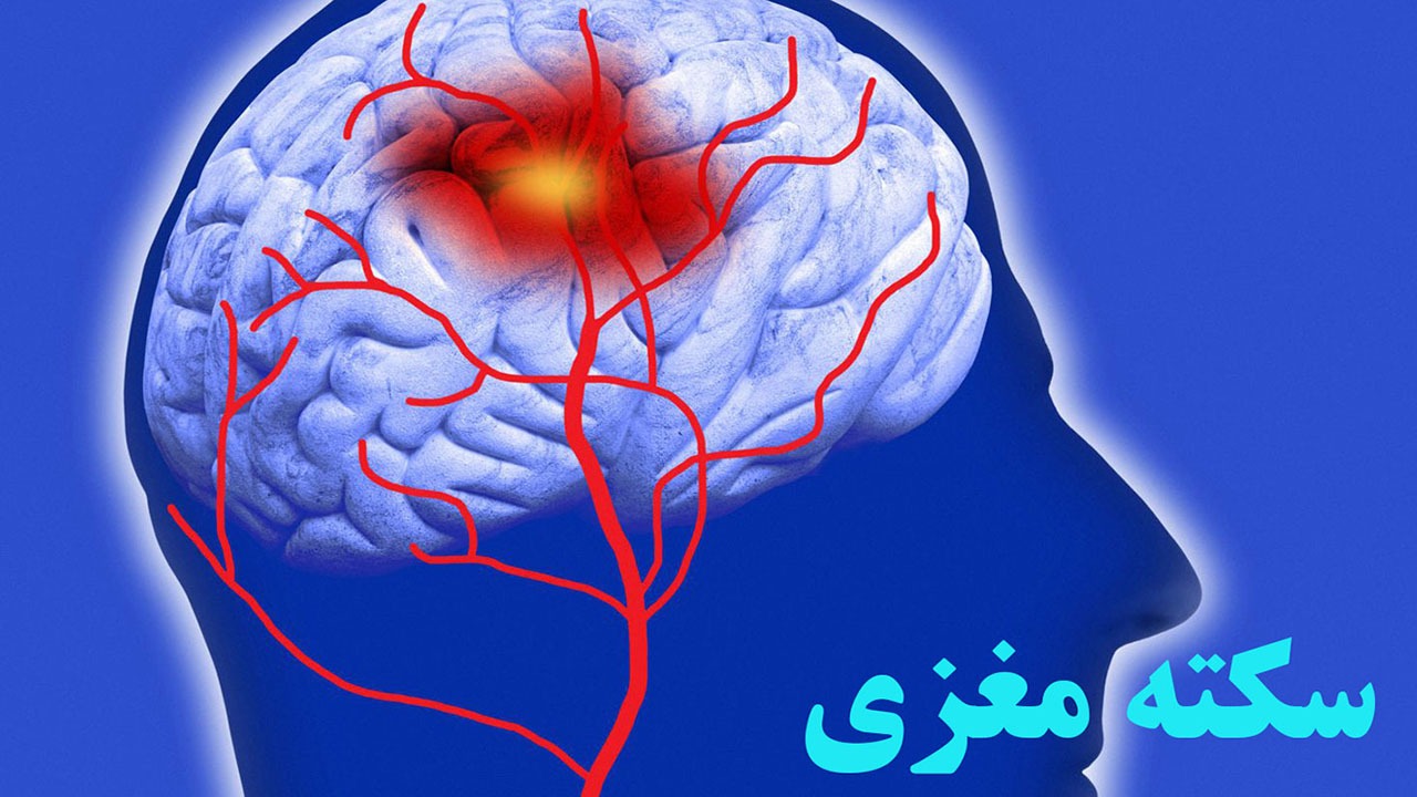 سکته مغزی و نشانه‌های آن چیست؟