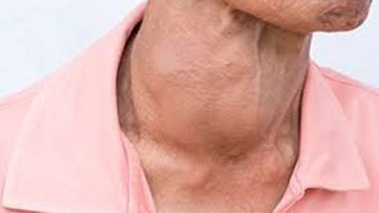همه چیز در مورد بیماری گواتر + فیلم