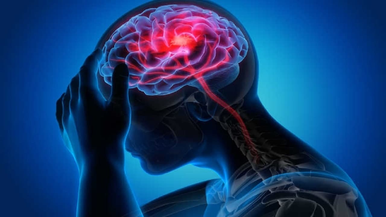 سکته مغزی سکته مغزی
