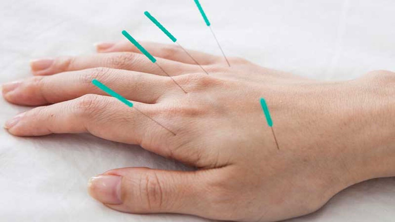 کاربردهای طب سوزنی + فیلم