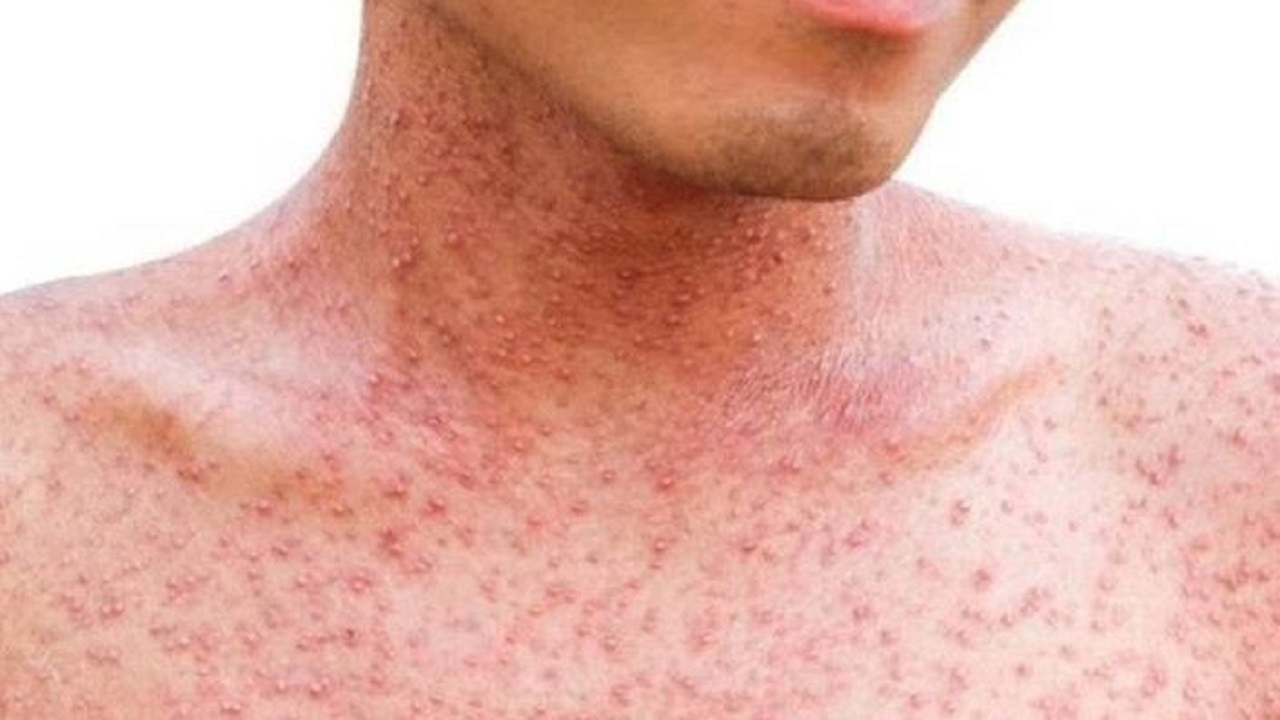 شناسایی ۲ مورد بیمار مشکوک به سرخک در آذربایجان غربی/ترددهای مرزی کنترل می شود