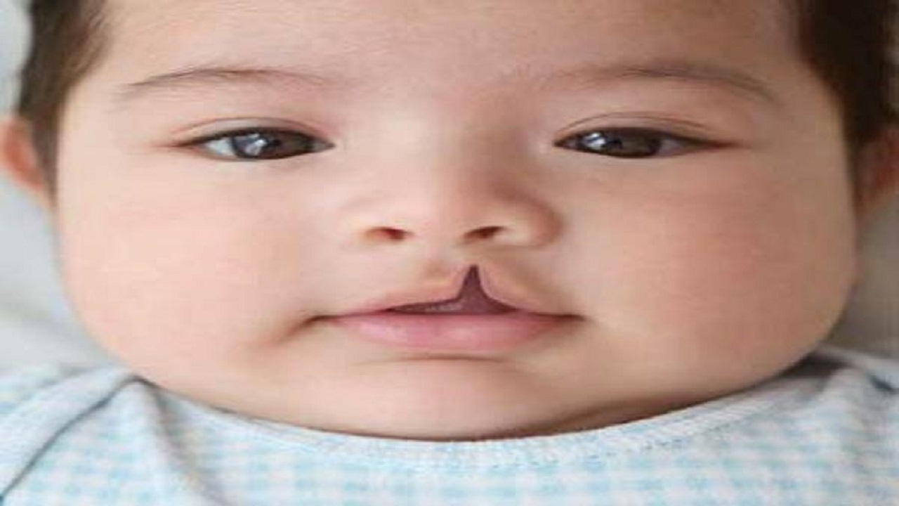 راهکارهای درمانی شکاف کام یا لب